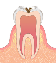 C2 神経に近い虫歯