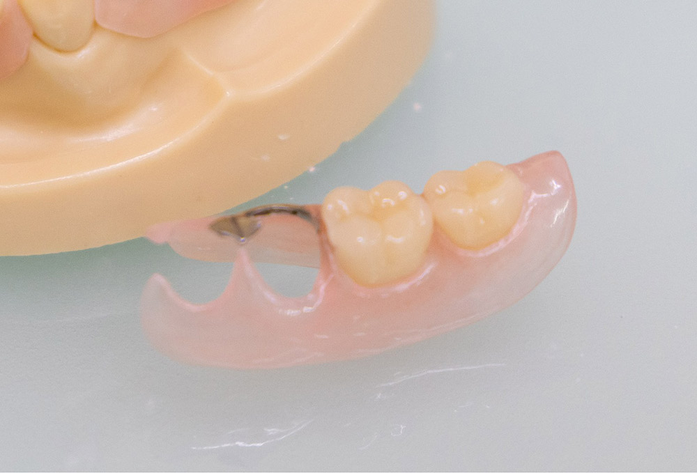 ノンクラスプデンチャー（部分入れ歯）