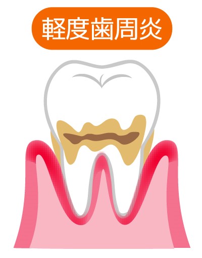 歯肉炎