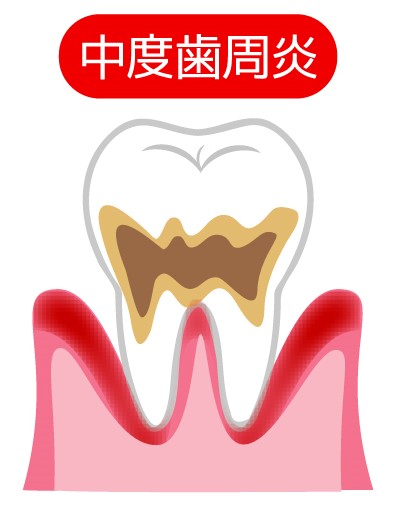 軽度の歯周炎